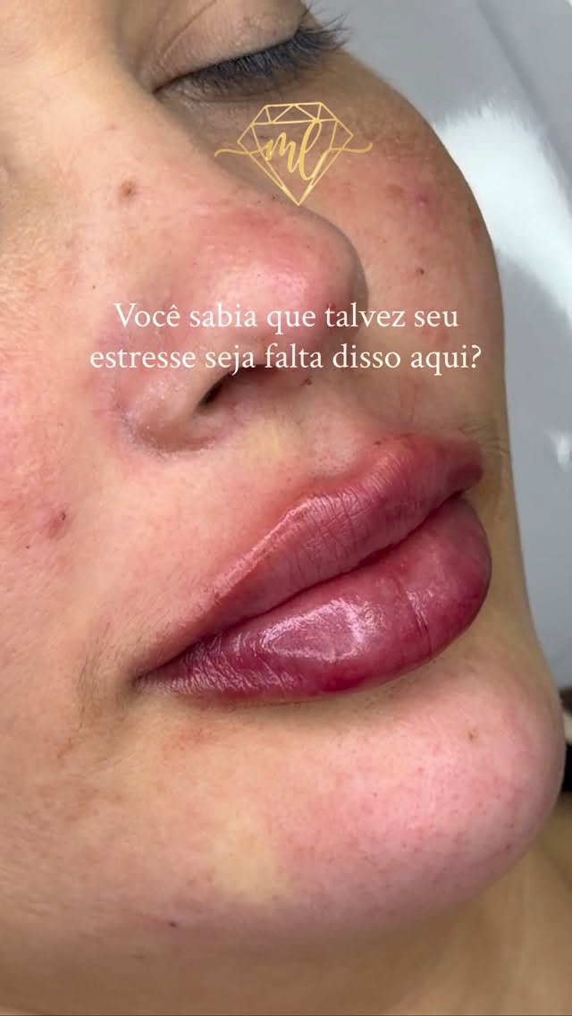 Close de lábios em conteúdo de preenchimento